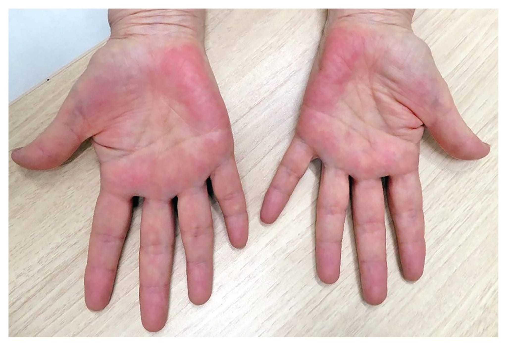 Bild Der Woche Rote H nde Und Brennender K rper what-causes-pomegranate-fruits-to-crack-or-split